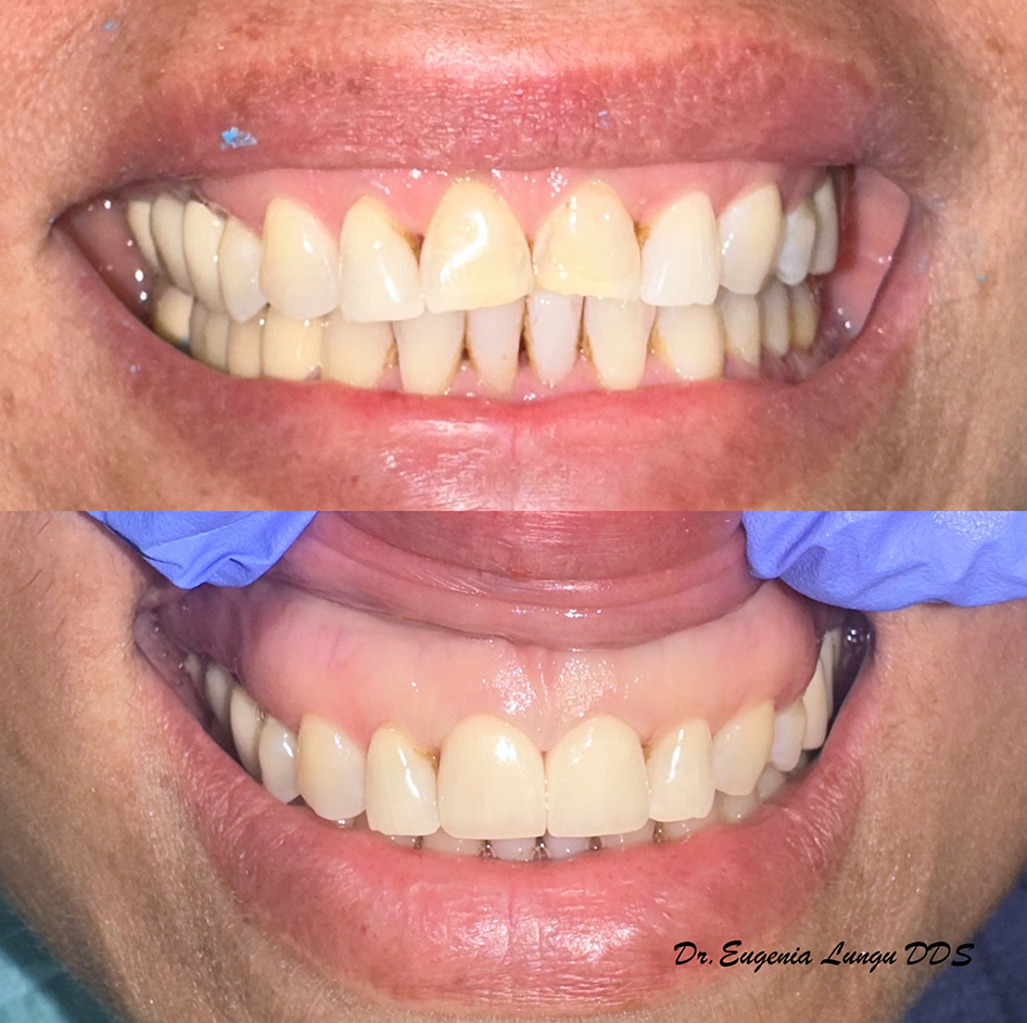 Before and after front tooth dental veneers
