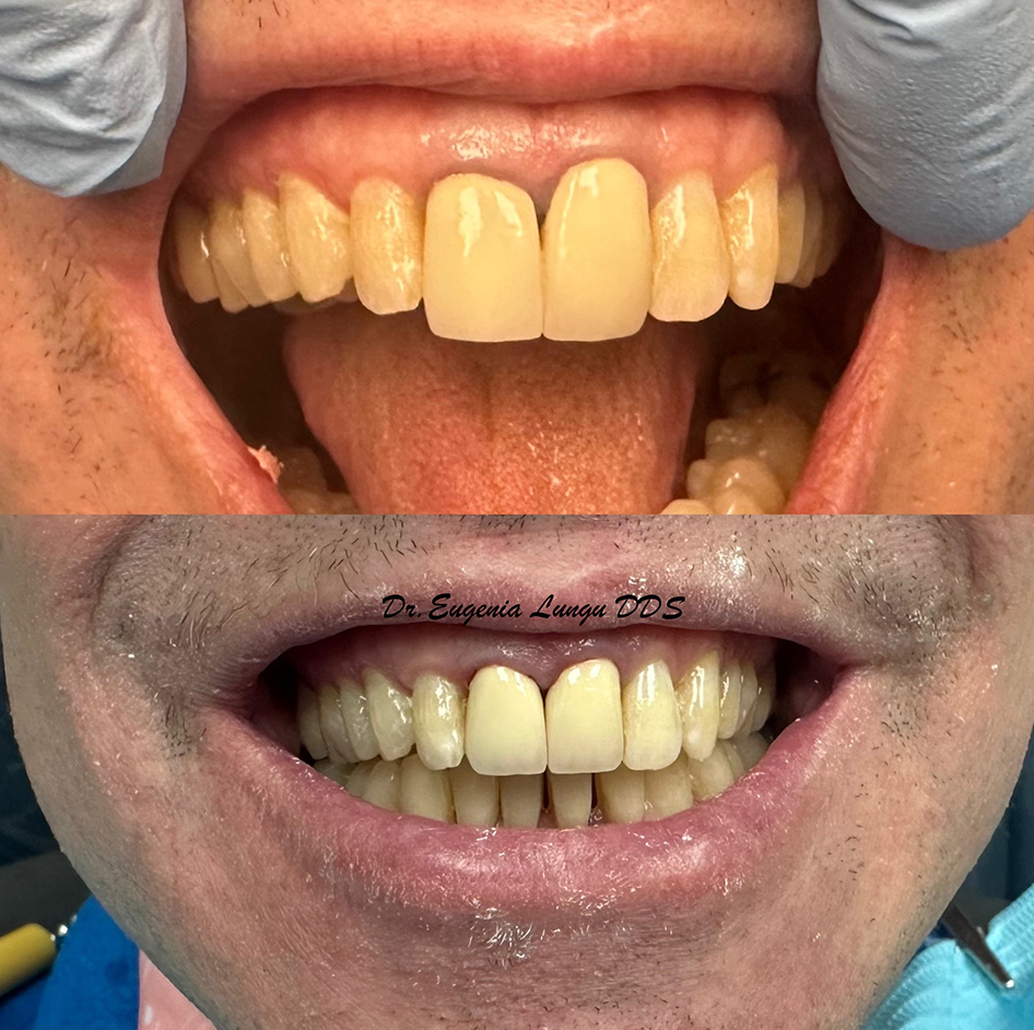 Teeth bleaching treatment results before and after