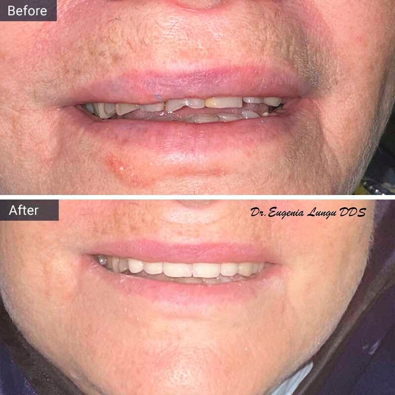 Dental Bonding Before After Vitadent Brooklyn, NY