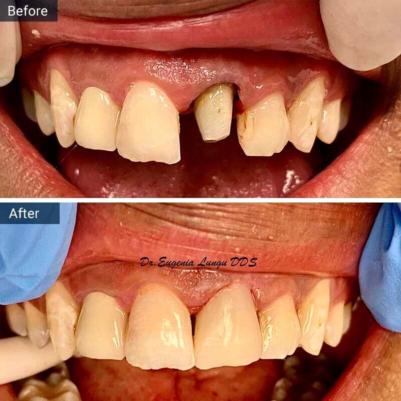 Dental Bridge Before After Vitadent Brooklyn, NY
