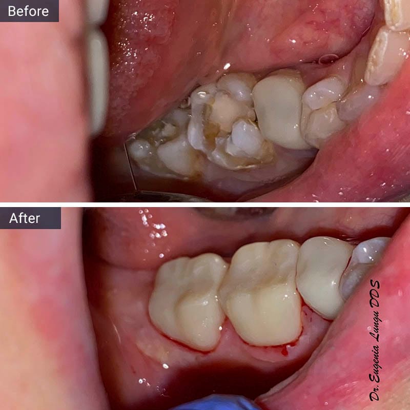 Dental Crown Before After Vitadent Brooklyn, NY