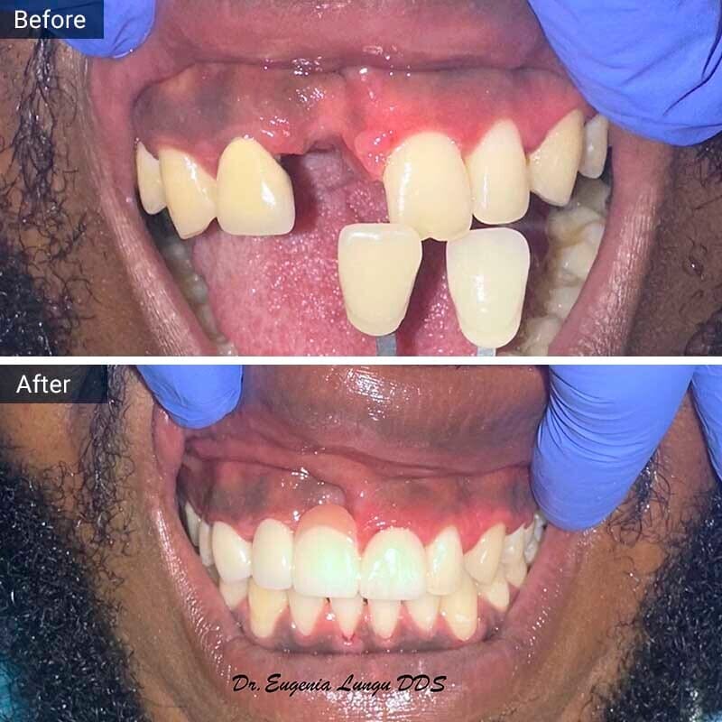 Dental Implant Before After Case-2 Vitadent Brooklyn, NY