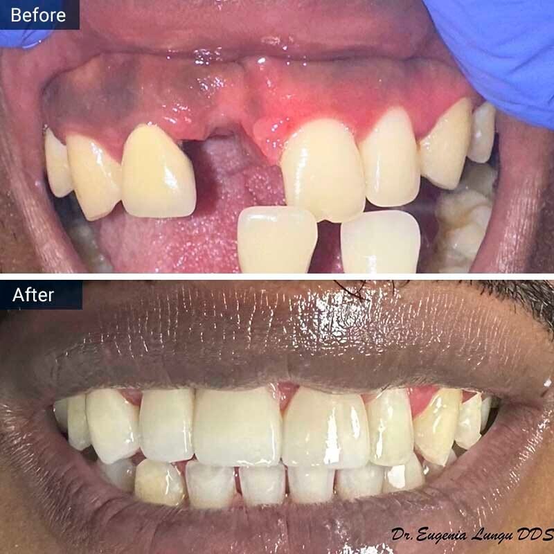 Dental Implant Before After Case-3 Vitadent Brooklyn, NY