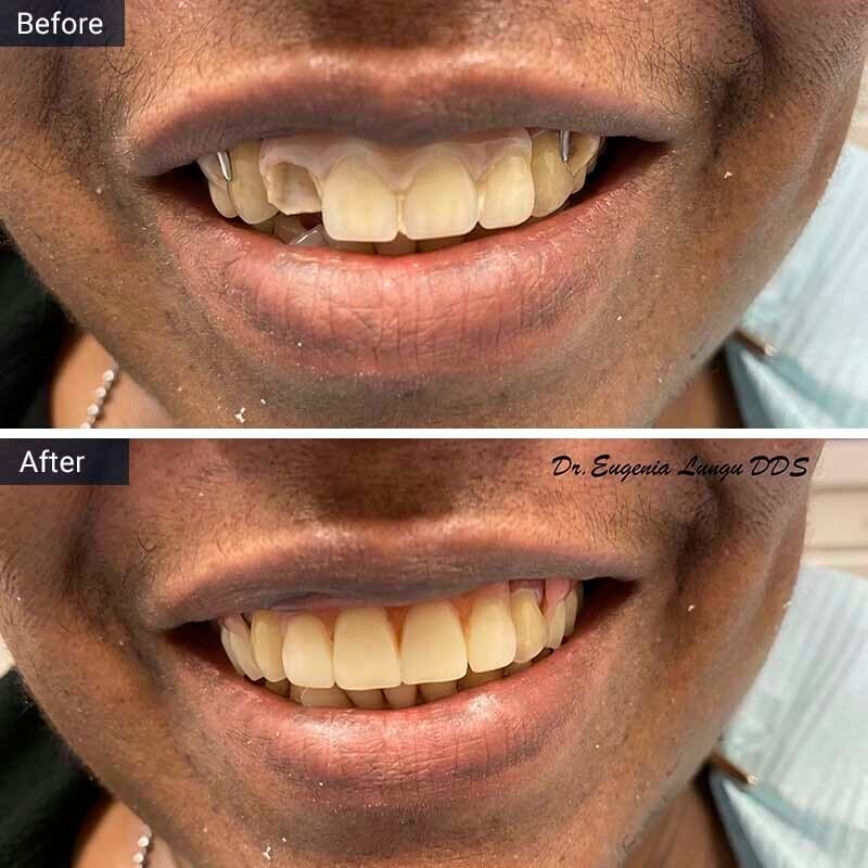 Dental Implant Before After Case-4 Vitadent Brooklyn, NY