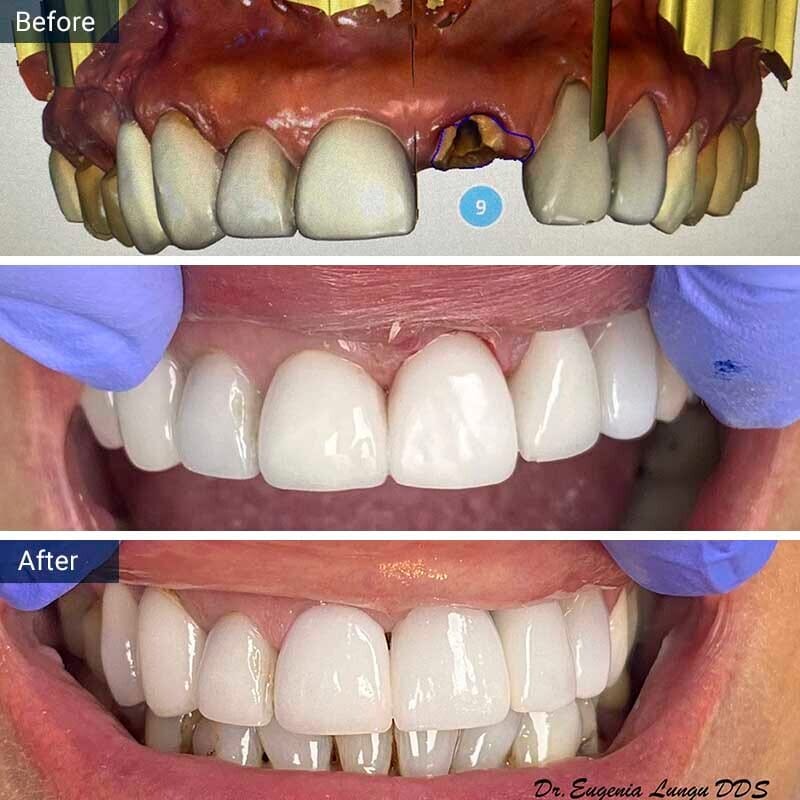 Dental Implant Before After Vitadent Brooklyn, NY