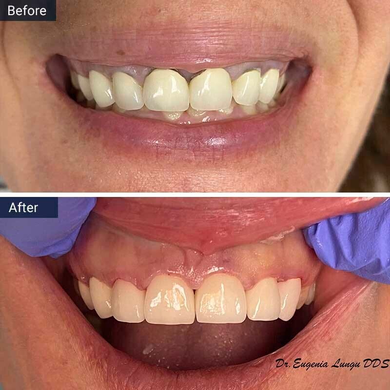 Gum Contouring Before After Vitadent Brooklyn, NY