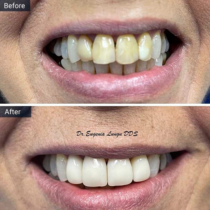 Teeth Whitening Before After Vitadent Brooklyn, NY