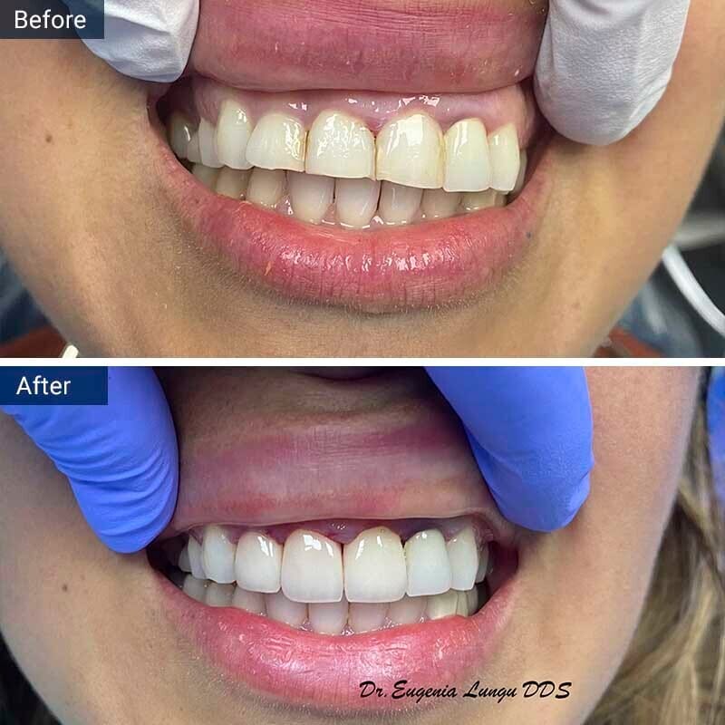 Veneers Before After Vitadent Brooklyn, NY