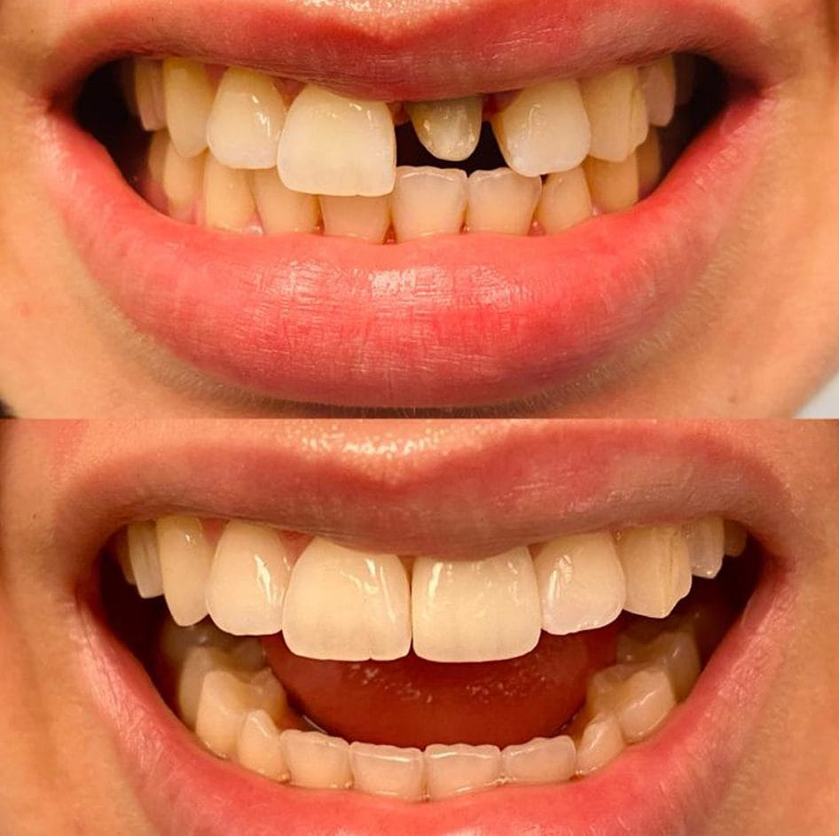 Before and After 04