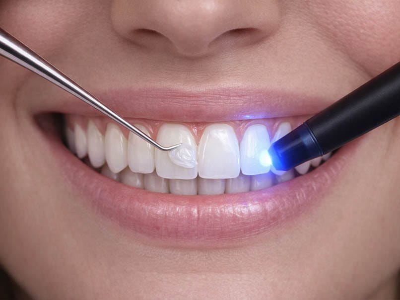 Dental bonding procedure repairing a front tooth using composite resin