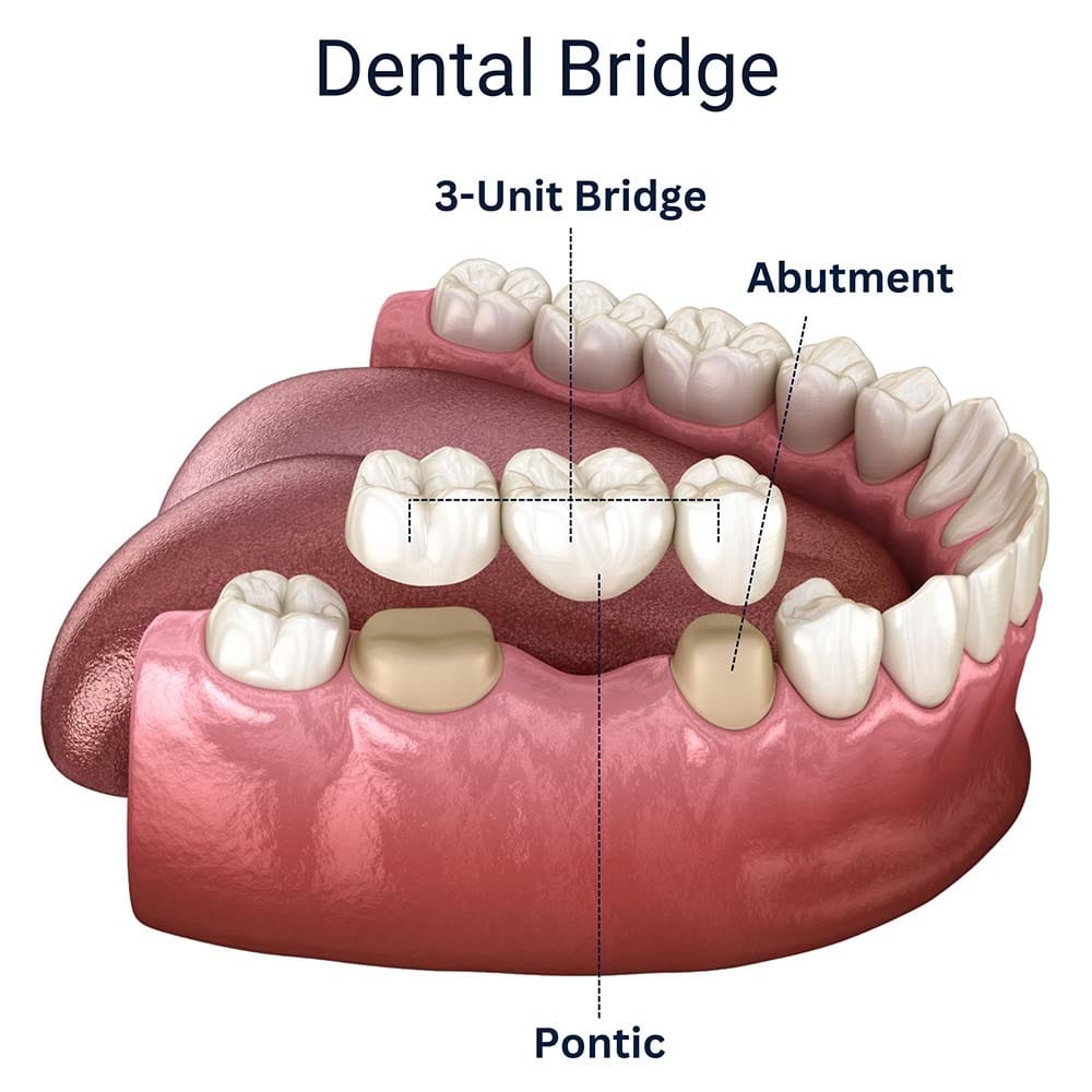 3D illustration of a 3-unit dental bridge with abutment teeth and pontic at VitaDent Brooklyn Dental Group