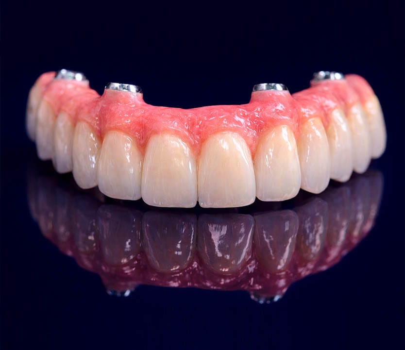 Fixed full arch dental implant restoration showing an implant-supported bridge replacing an entire row of missing teeth