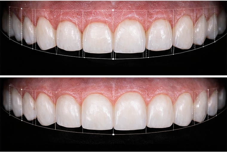 Before and after gum contouring showing digital smile design planning and improved gingival margins
