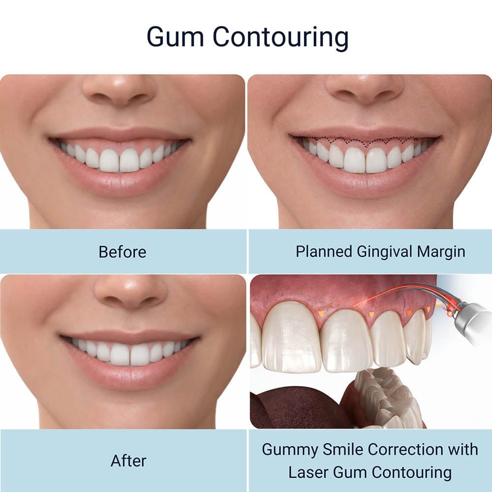 Laser gum contouring before and after showing planned gingival margin and gummy smile correction