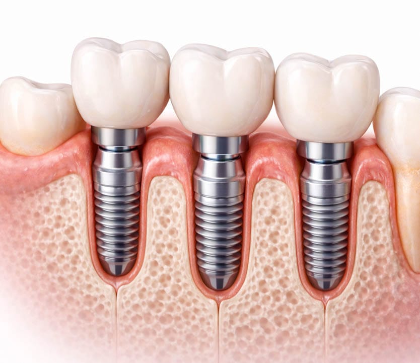 Multiple teeth replacement using dental implants to support individual crowns