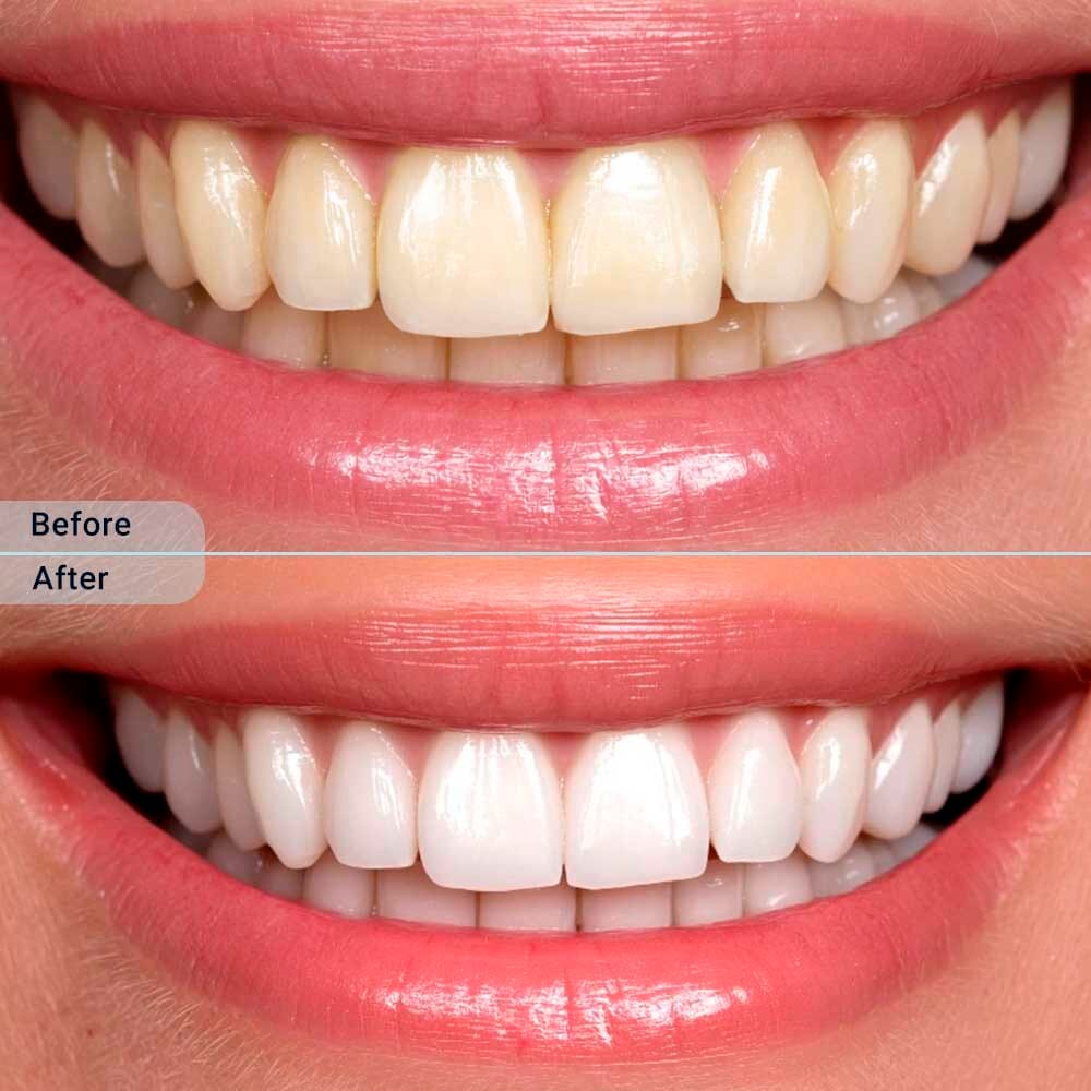 Before and after professional teeth whitening results at VitaDent Brooklyn Dental Group.