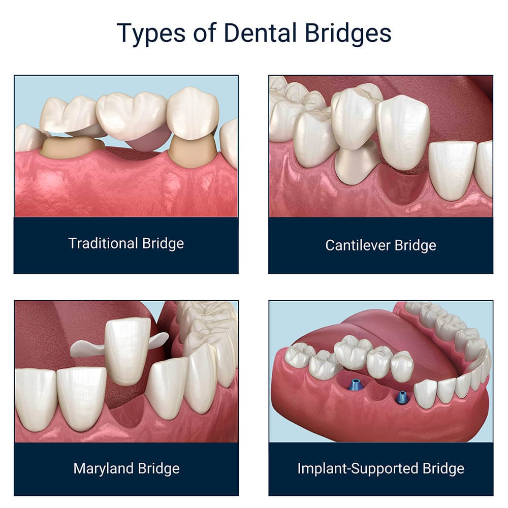 Types of Dental Bridges
