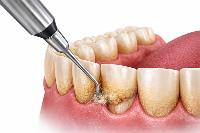 illustration showing deep teeth cleaning with ultrasonic scaler removing tartar from below the gumline.
