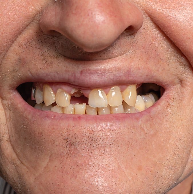 Knocked out Tooth
