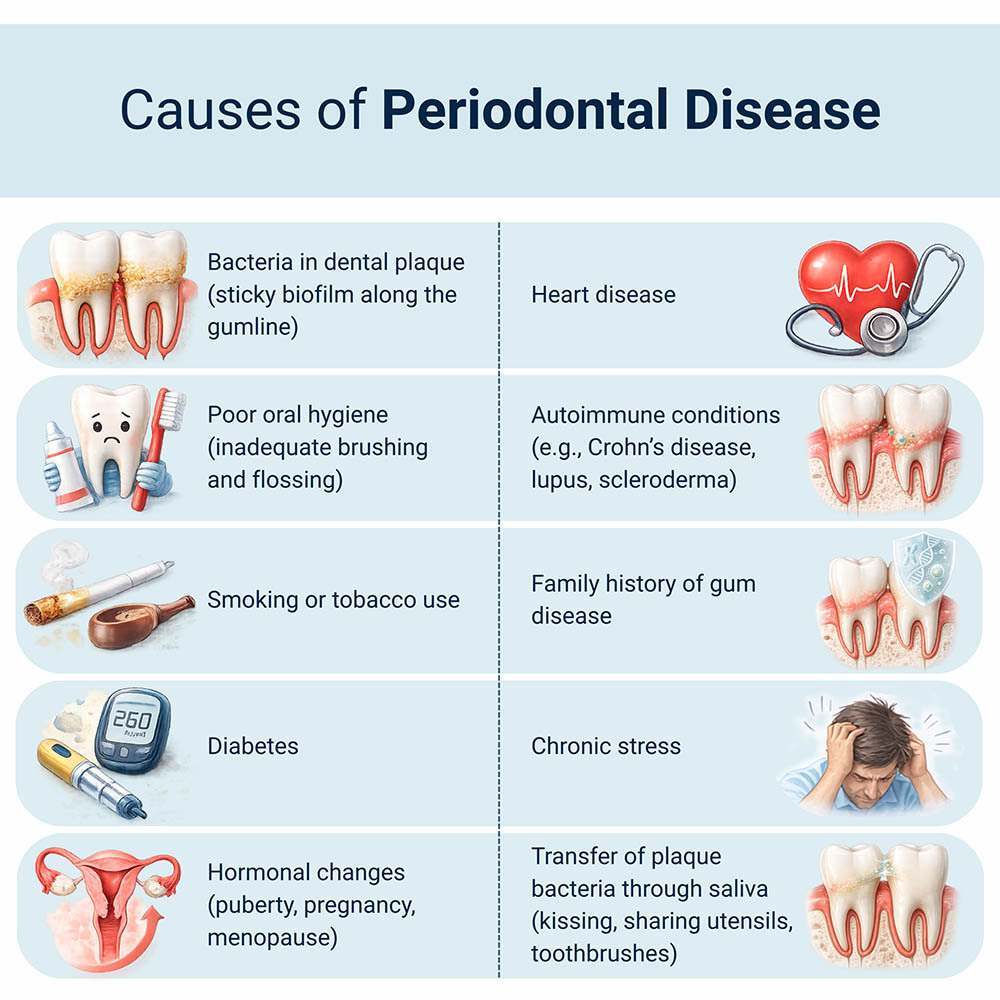 Infographic showing common causes of periodontal disease including dental plaque, poor oral hygiene, smoking, diabetes, hormonal changes, autoimmune conditions, family history, stress, and bacterial transmission