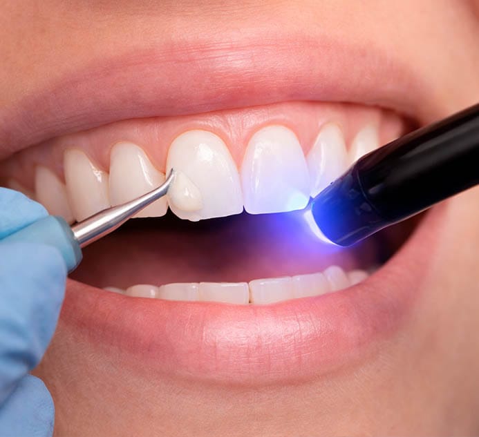 Dental bonding treatment at VitaDent Brooklyn on Avenue X in Sheepshead Bay, Brooklyn 11235, restoring chipped or uneven teeth for improved smile appearance.