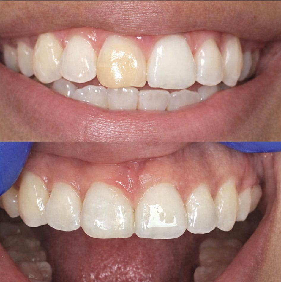 Dental Bonding Before After Smile Restoration Brooklyn, NY