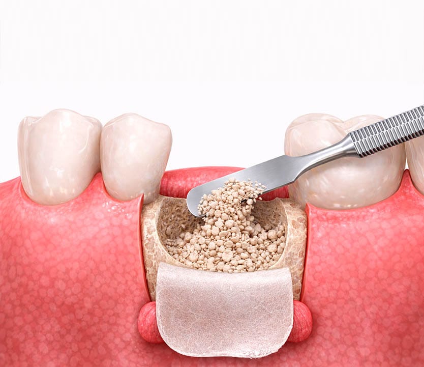 Dental Bone Graft Placement Vitadent Brooklyn