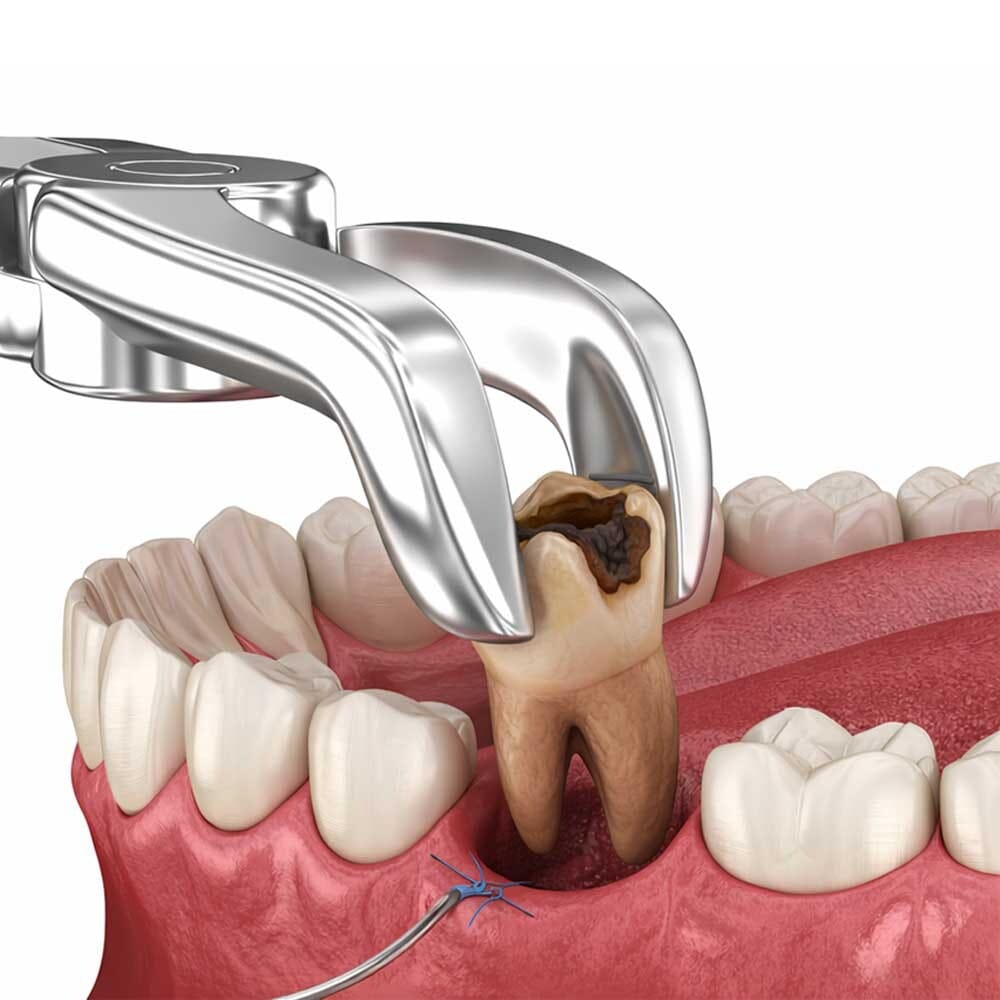 Medical illustration showing surgical tooth extraction using dental forceps for common oral surgery treatment