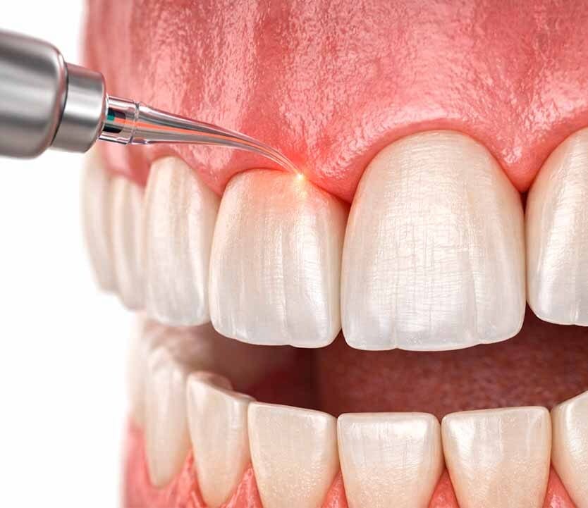 medical illustration of laser gum surgery reshaping the gumline around upper front teeth in Brooklyn, NY