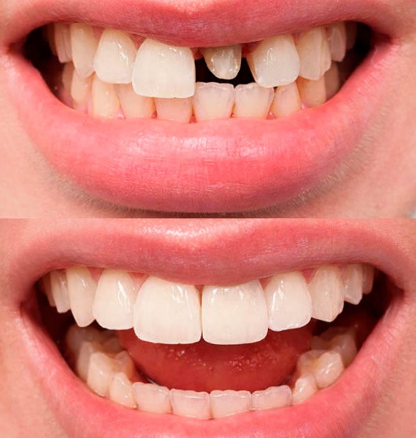 Before and after dental restoration showing repair of a missing front tooth at VitaDent Brooklyn