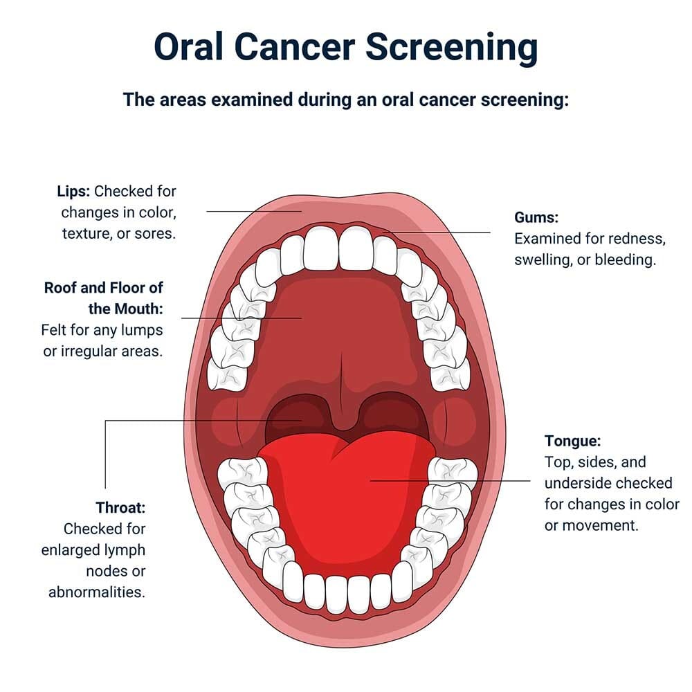 Diagram showing the areas examined during an oral cancer screening, including lips, gums, tongue, throat, and mouth tissues.