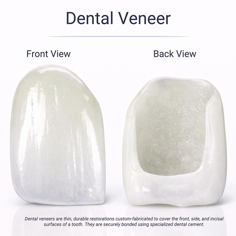 Porcelain dental veneer front and back view at VitaDent Brooklyn Dental Group