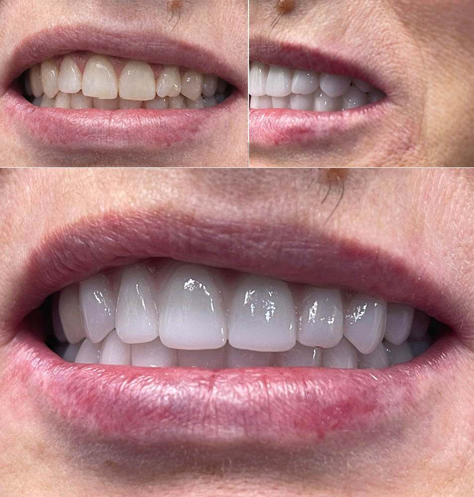 Porcelain Veneers Before After Vitadent Brooklyn
