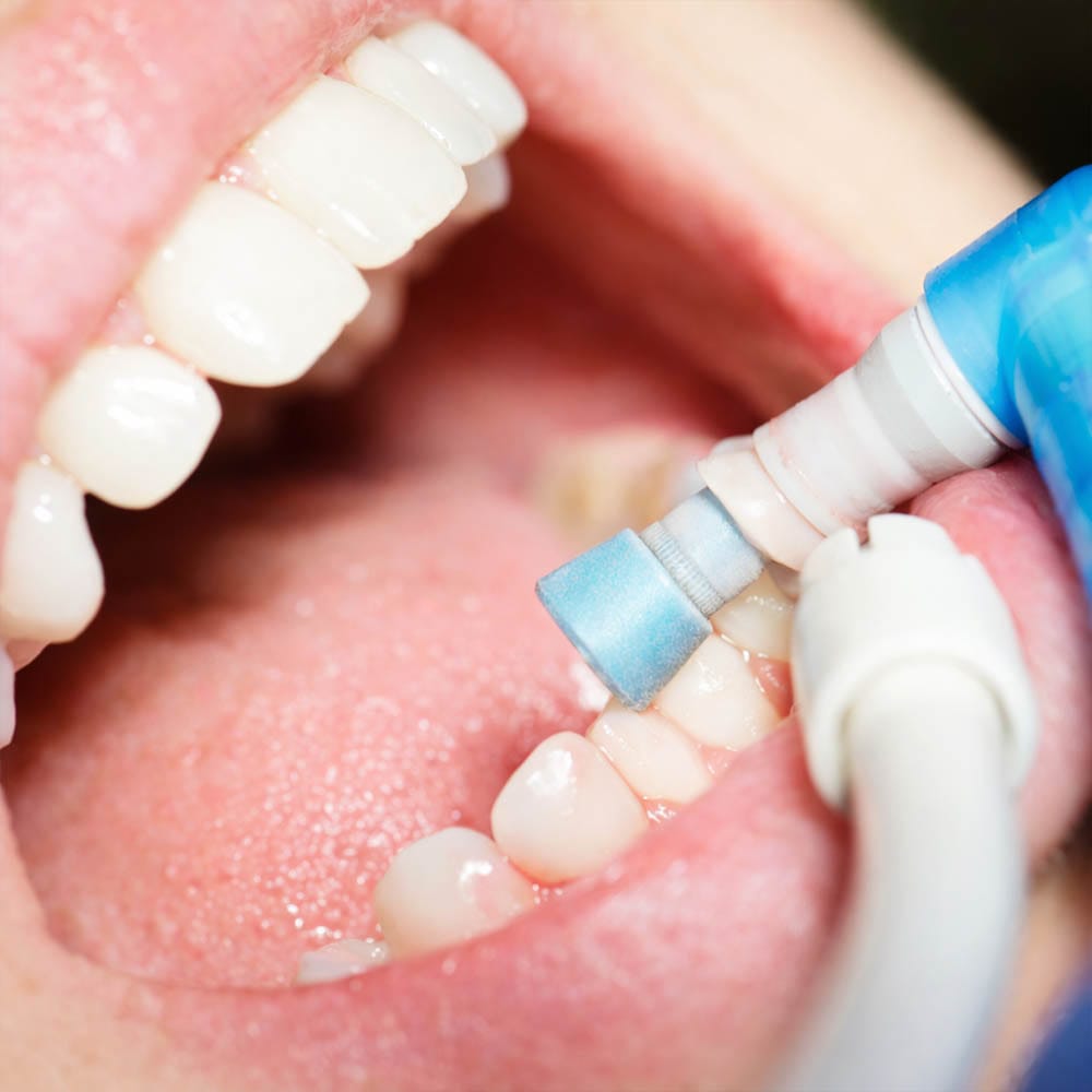 Professional routine dental cleaning at VitaDent Brooklyn