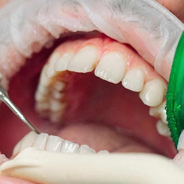 Professional Teeth Cleaning