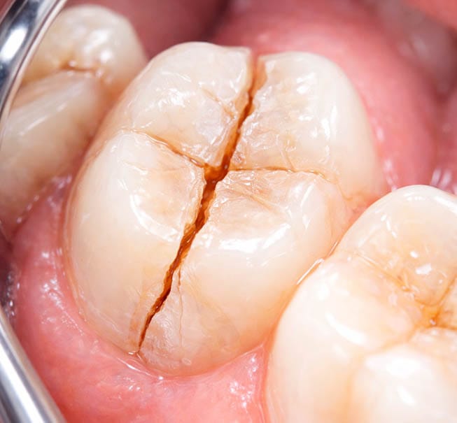 Severely cracked molar showing deep enamel fracture for emergency dental treatment in Brooklyn