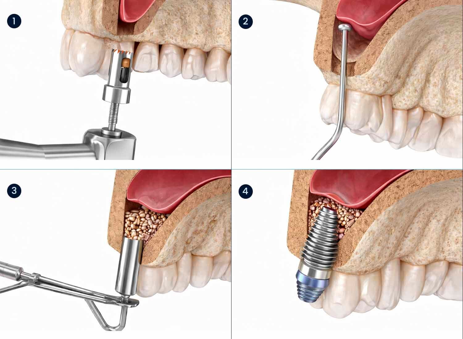 Medical illustration of sinus lift bone grafting procedure preparing the upper jaw for dental implant placement