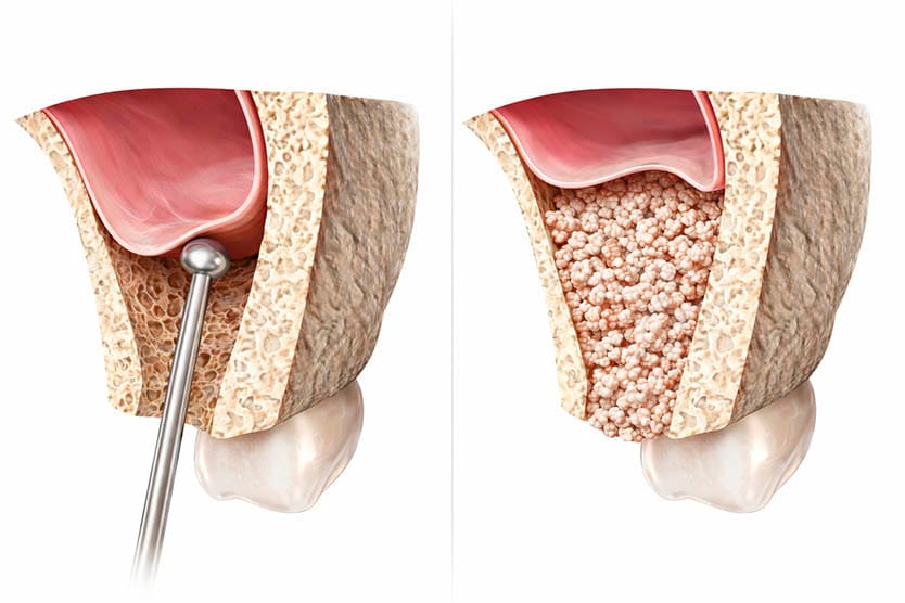 Sinus lift bone grafting procedure adding bone to the upper jaw to support dental implant placement