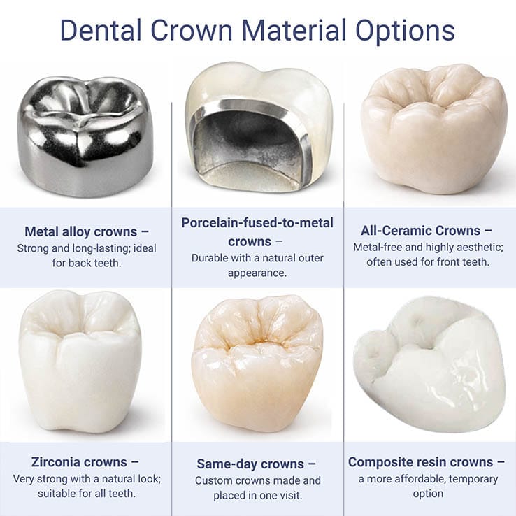 Infographic showing dental crown material options including metal, porcelain-fused-to-metal, ceramic, zirconia, same-day, and composite resin crowns