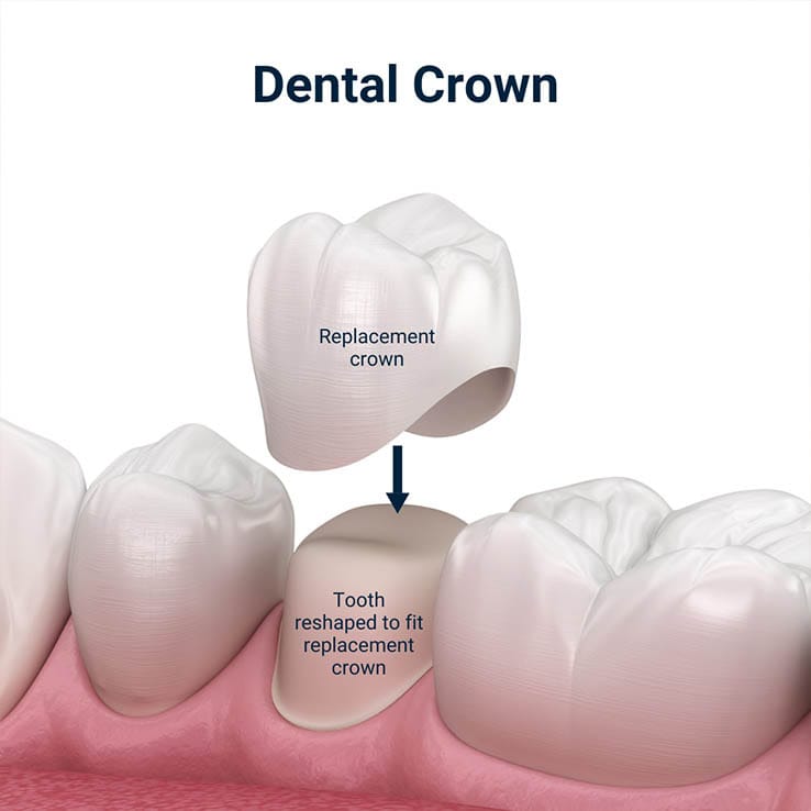 Anatomical illustration of a dental crown placed on a prepared tooth for dental crown treatment in Sheepshead Bay, Brooklyn