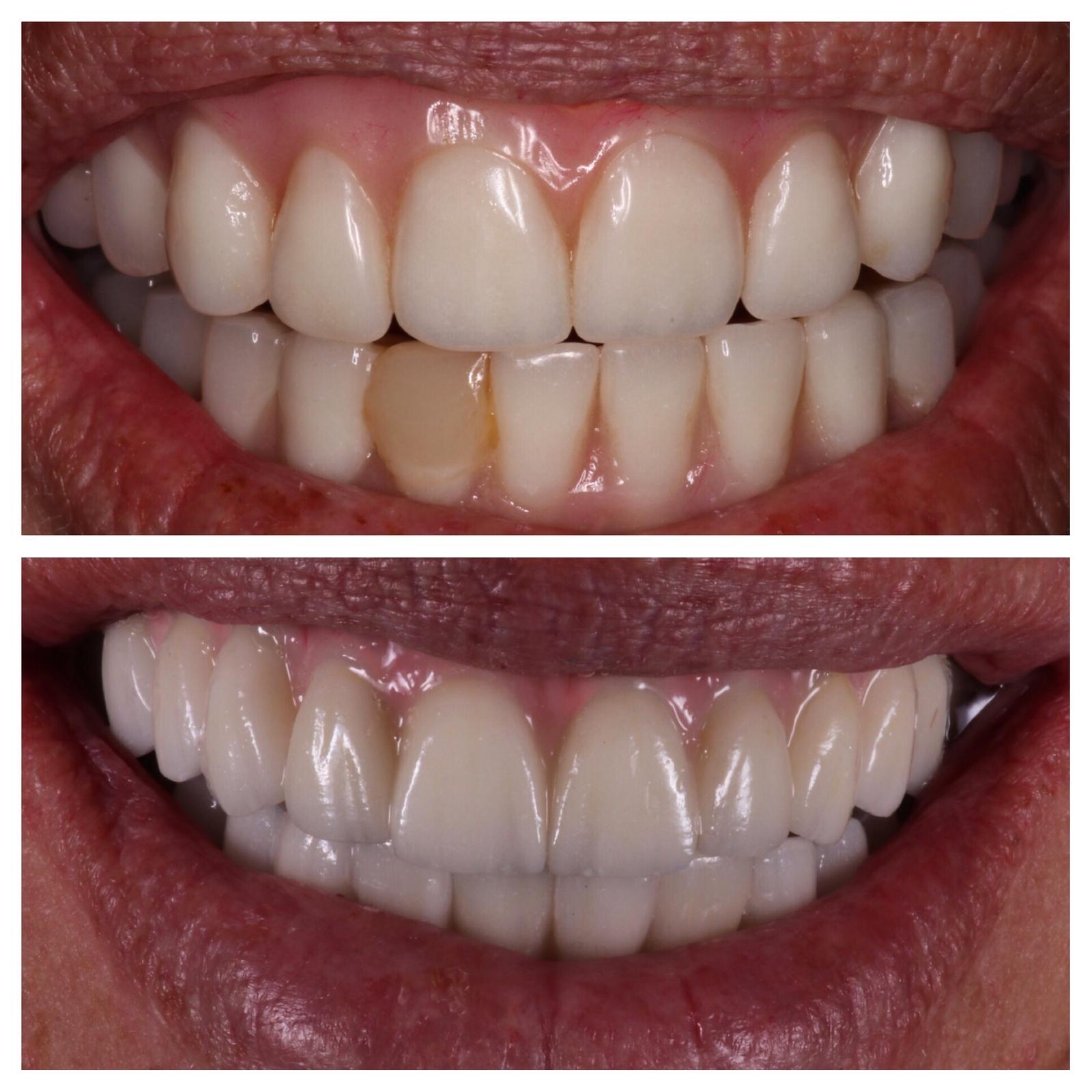 Vitadent Brooklyn Porcelain Veneers Before After Smile Makeover