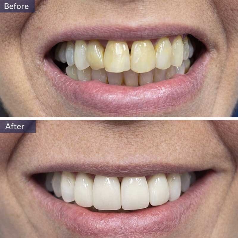 Deep Dental Cleaning Before and After Results
