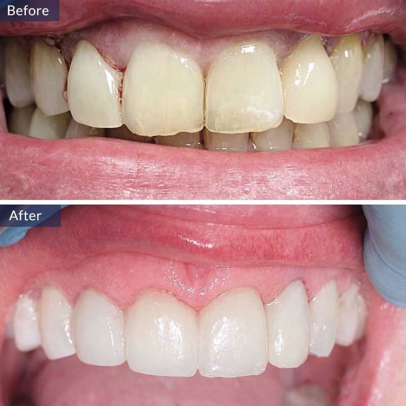 Deep Dental Cleaning Before and After Results Case 2