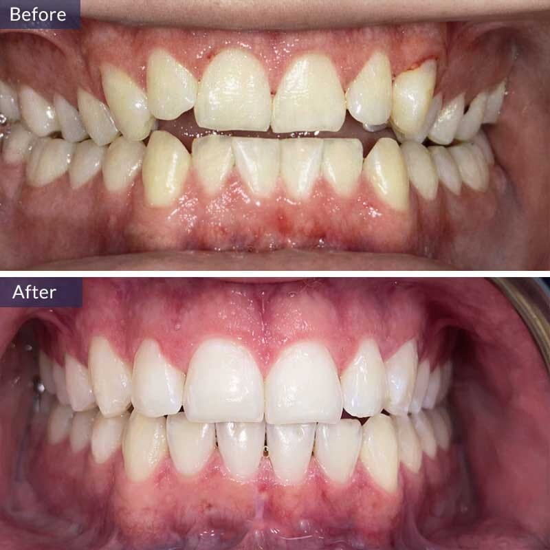 Deep Dental Cleaning Before and After Results Case 3