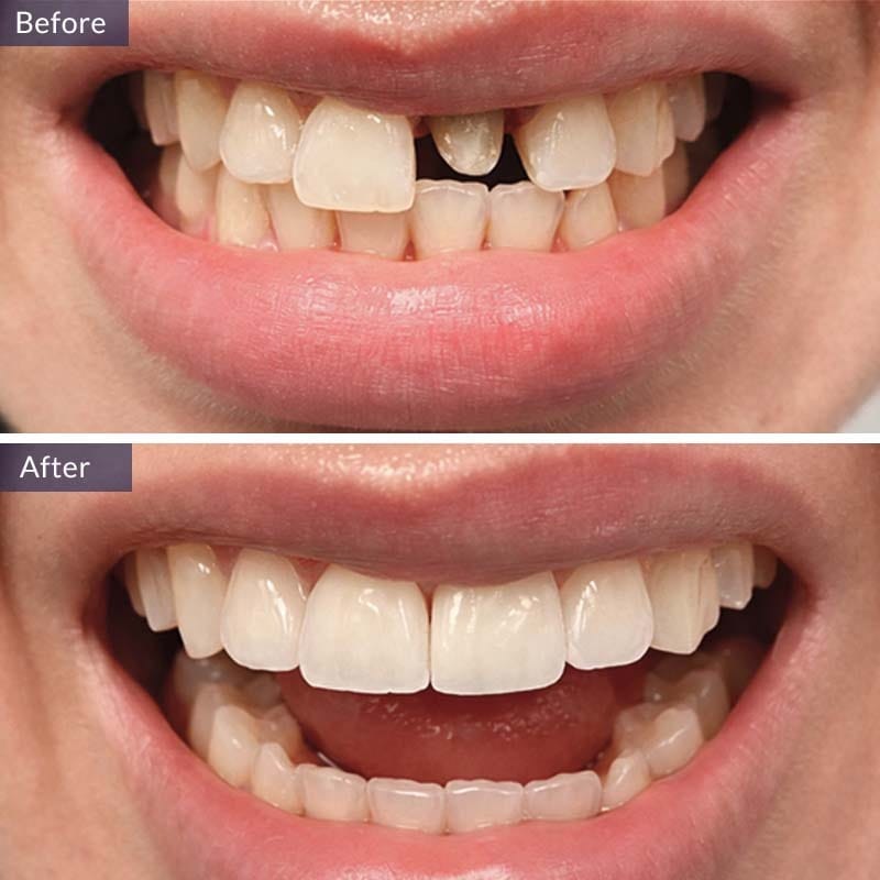 Dental Crown Before and After Results Case 1