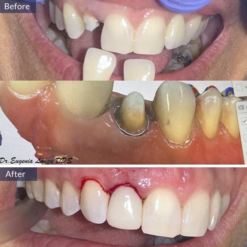 Dental Crown Before and After Results Case 2
