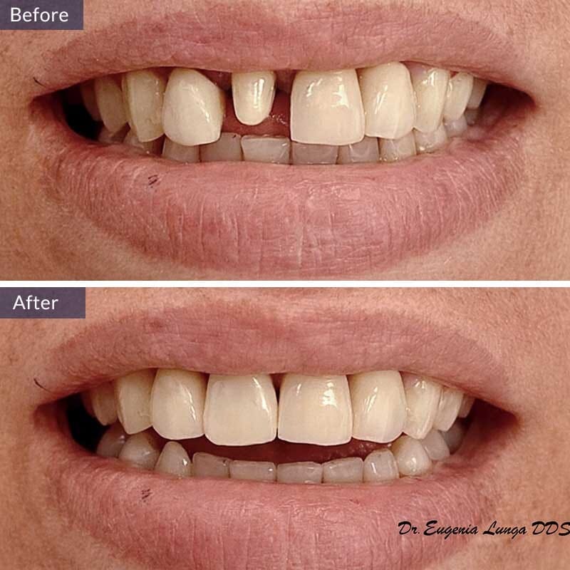 Dental Crown Before and After Results Case 3