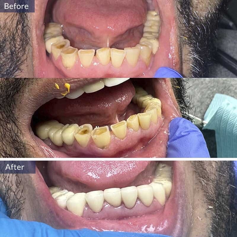 Dental Crown Before and After Results Case 4
