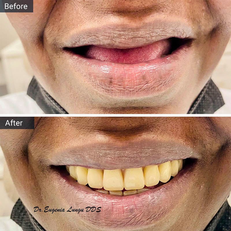 Dentures Before and After Result