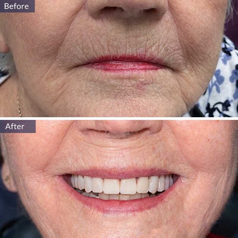 Dentures Before and After Result Case 2